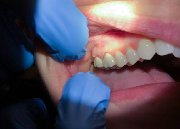 Best Emergency Wisdom Tooth Extraction in Desoto Lakes, FL